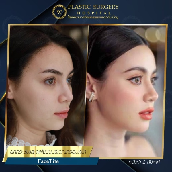 ดูดไขมันเหนียงใต้คาง (FaceTite)