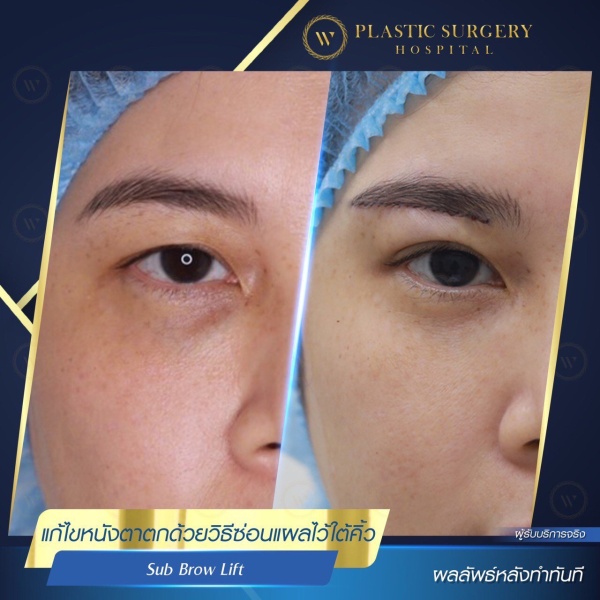 หนังตา/หางตาบนตก