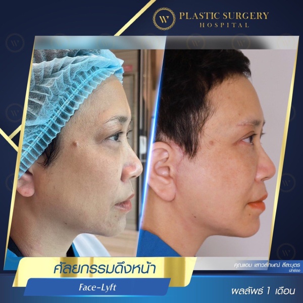 ดึงหน้า