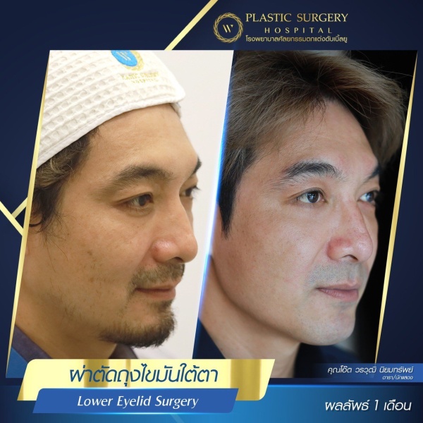 Lower Eyelid Surgery
