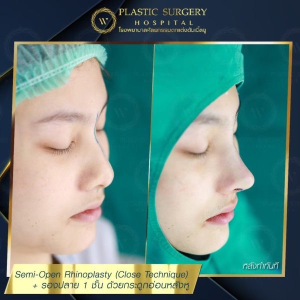 เสริมจมูก