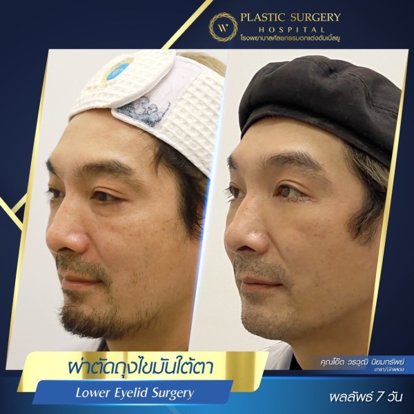 ตัดถุงไขมันใต้ตา