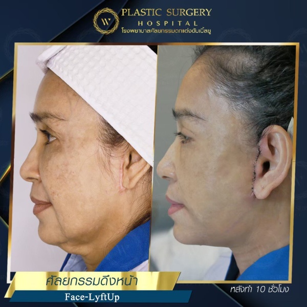 ดึงหน้า