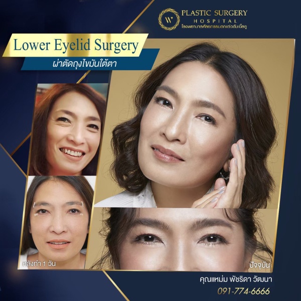 ตัดถุงไขมันใต้ตา