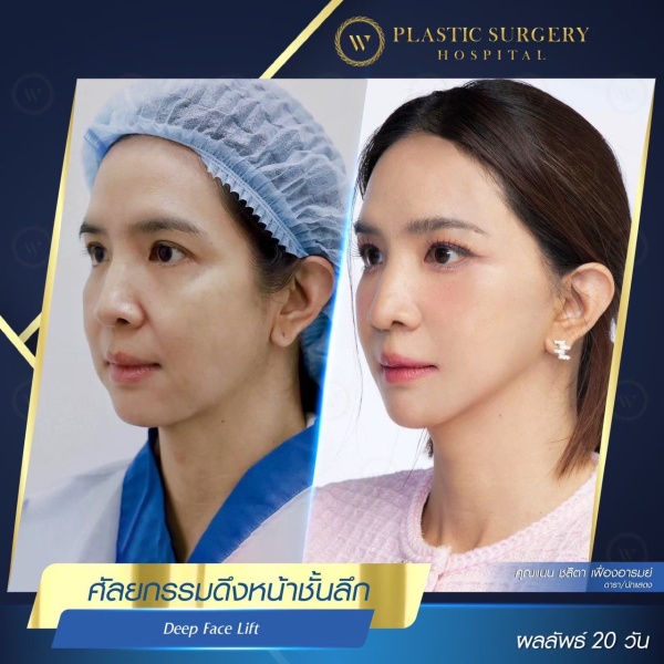 ดึงหน้า