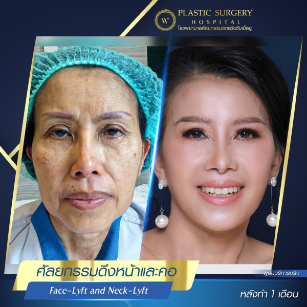 ดึงหน้า