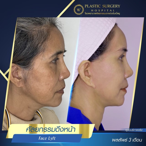 ดึงหน้า