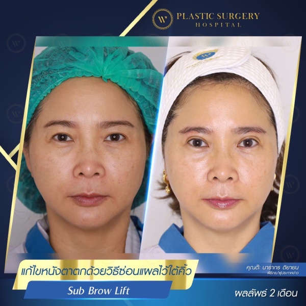 หนังตา/หางตาบนตก