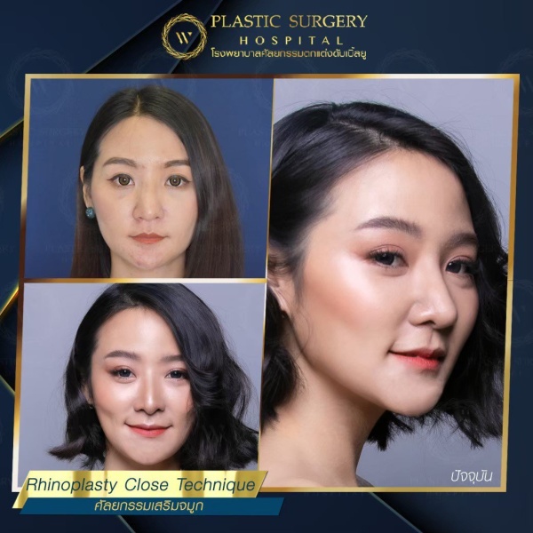 เสริมจมูก