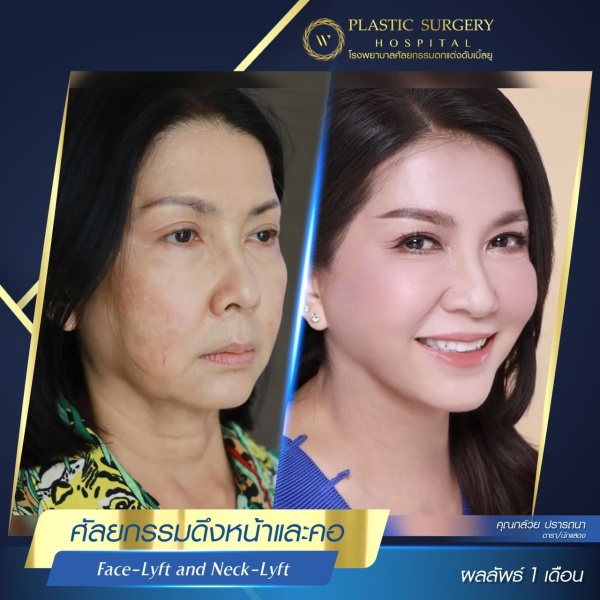 ดึงหน้า