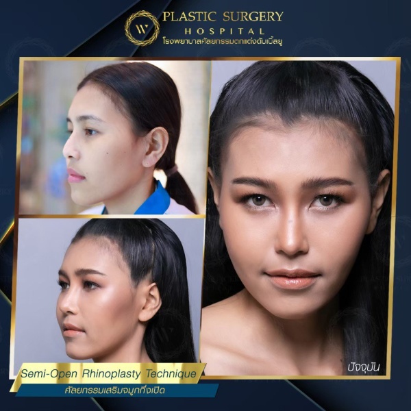 เสริมจมูก