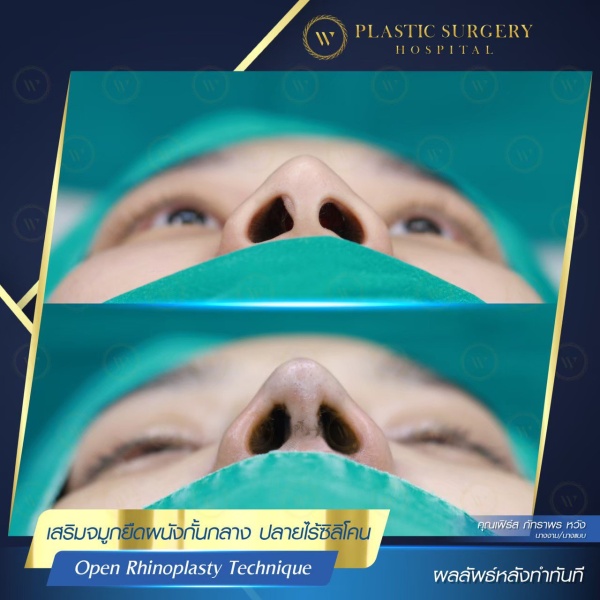 เสริมจมูก