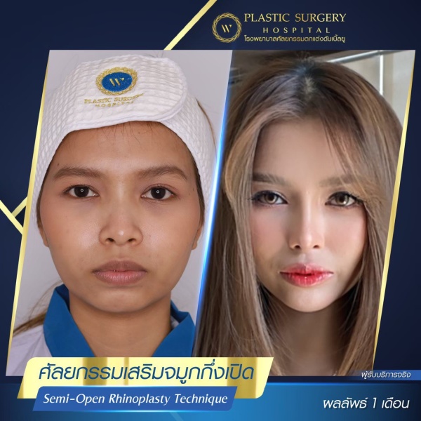 เสริมจมูก