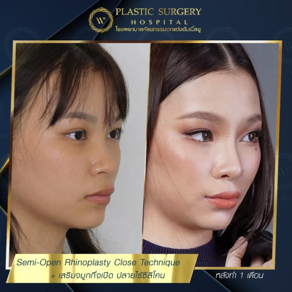 เสริมจมูก