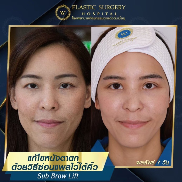 หนังตา/หางตาบนตก