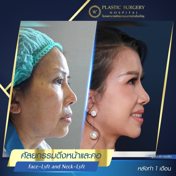 ดึงหน้า