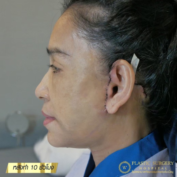 ดึงหน้า