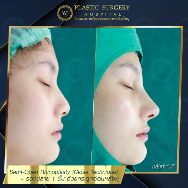 เสริมจมูก