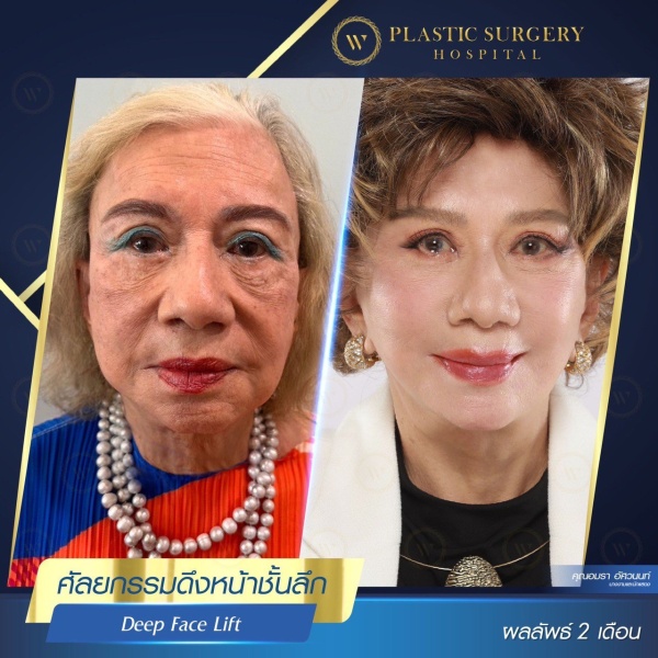 ดึงหน้า