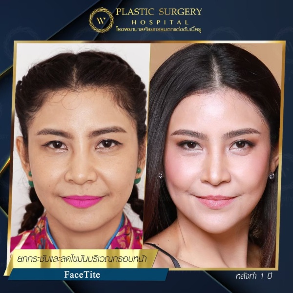 ดูดไขมันเหนียงใต้คาง (FaceTite)