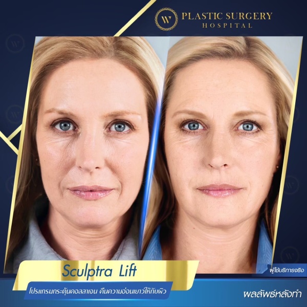 Sculptra Lift