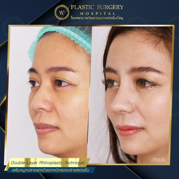 เสริมจมูก