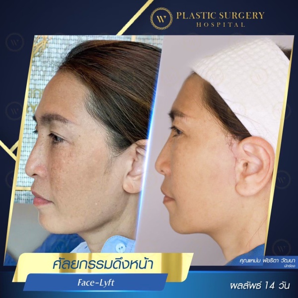 ดึงหน้า