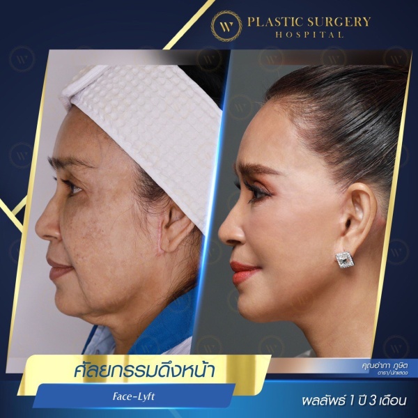 ดึงหน้า