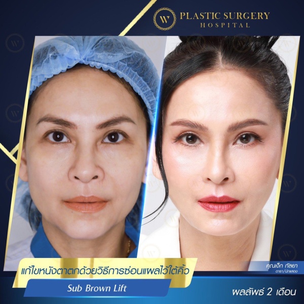 ศัลยกรรมแก้ไขปัญหาหนังตา