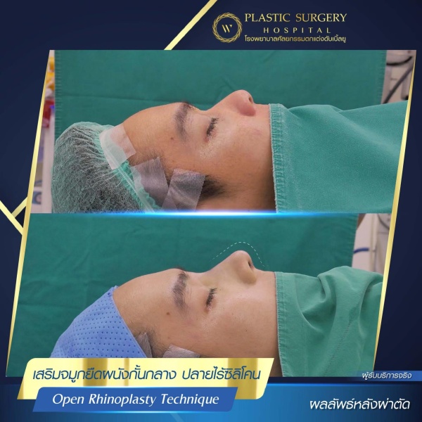 เสริมจมูก