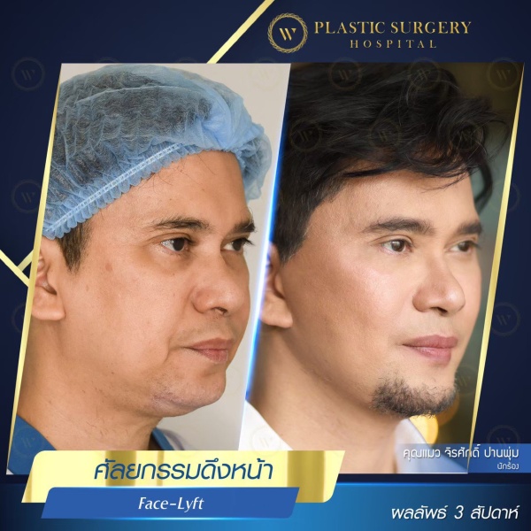 ดึงหน้า