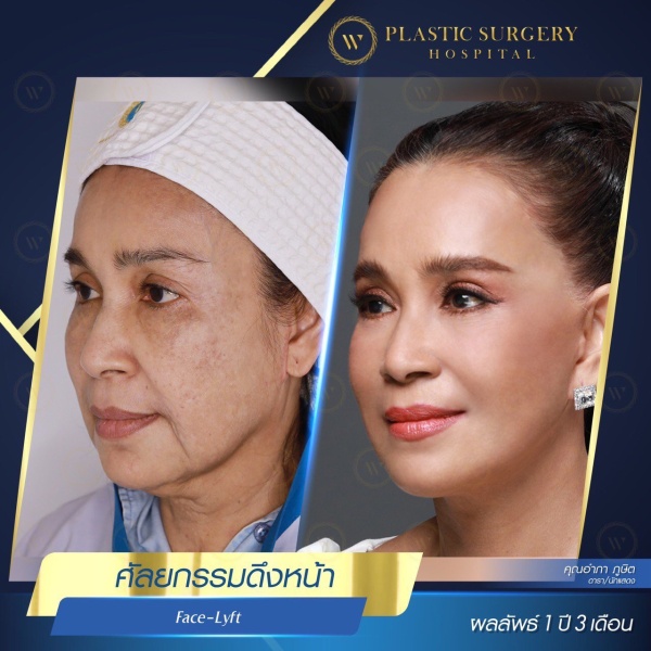 ดึงหน้า