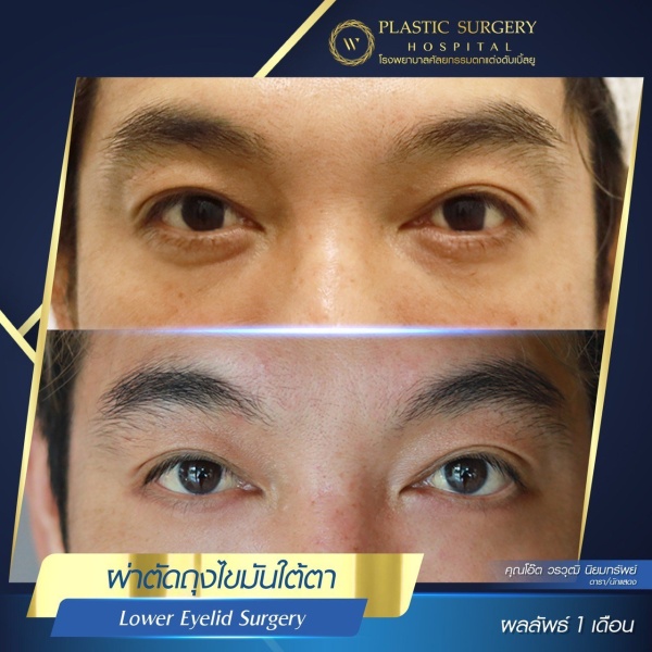 Lower Eyelid Surgery