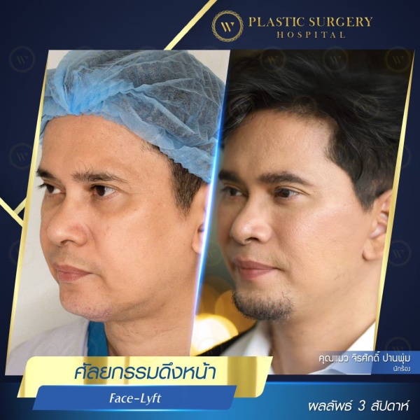 ดึงหน้า