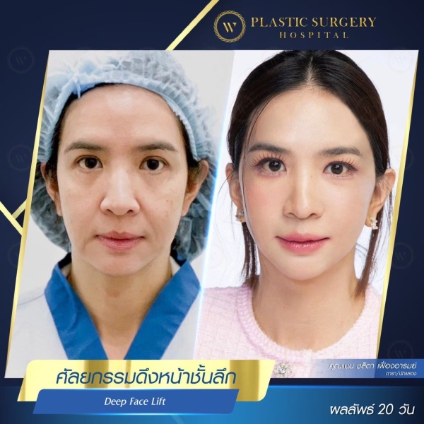 ดึงหน้า