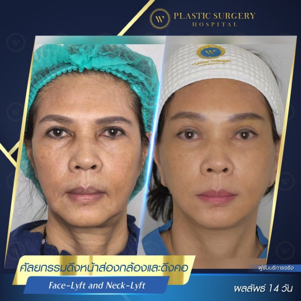 ดึงหน้า