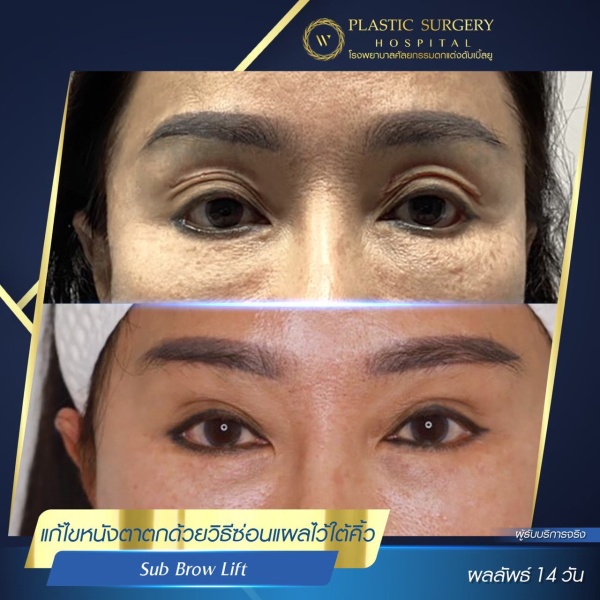 หนังตา/หางตาบนตก