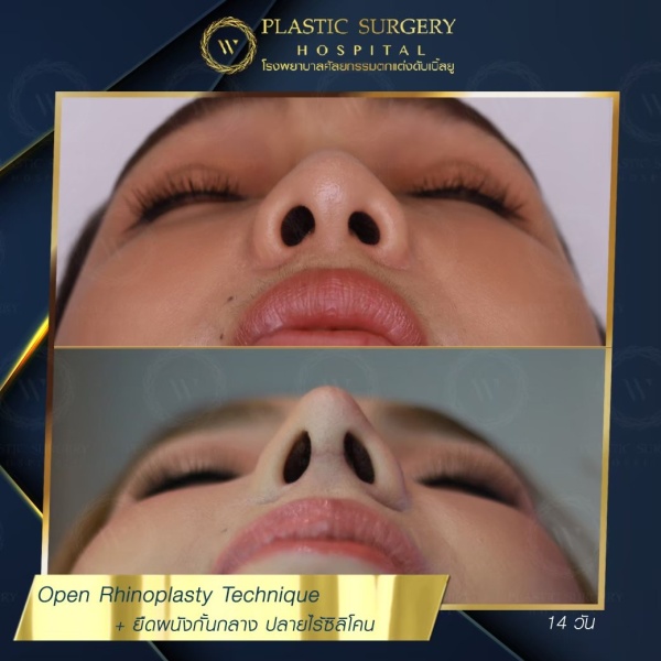 เสริมจมูก