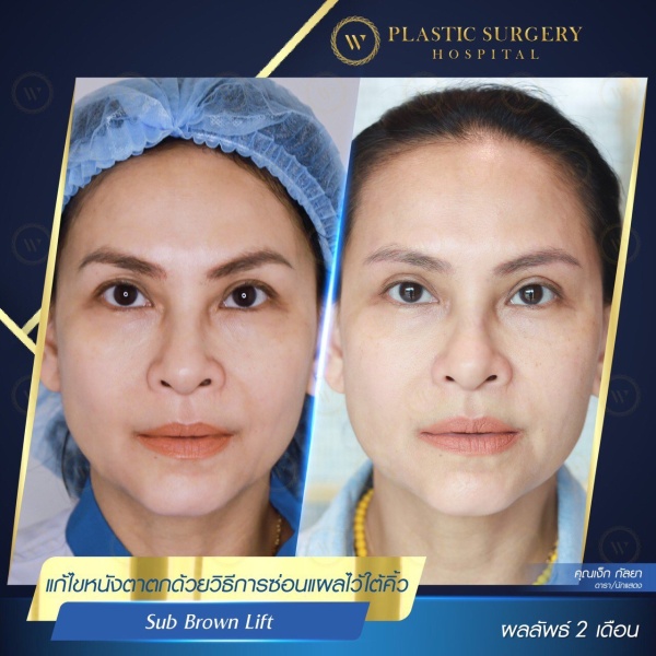 ศัลยกรรมแก้ไขปัญหาหนังตา