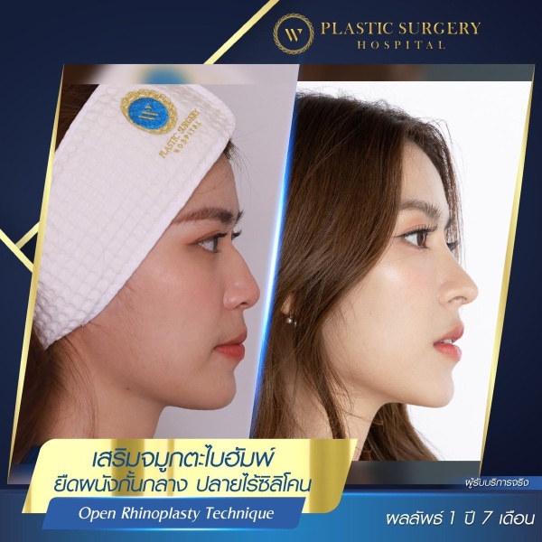 Nose Surgery