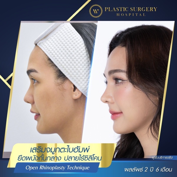 Nose Surgery