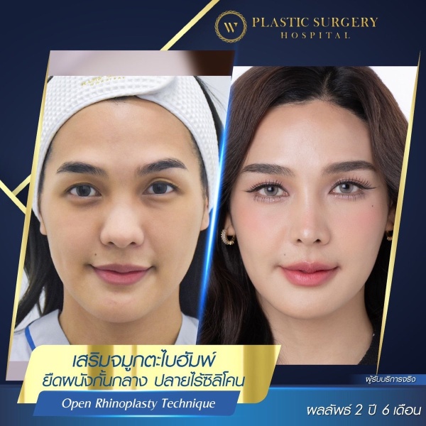 Nose Surgery