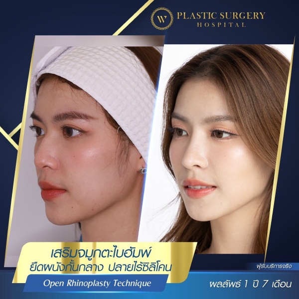 Nose Surgery