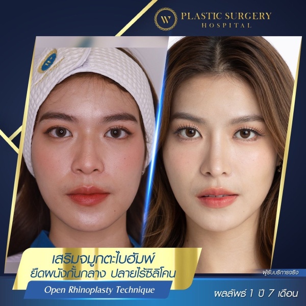 Nose Surgery