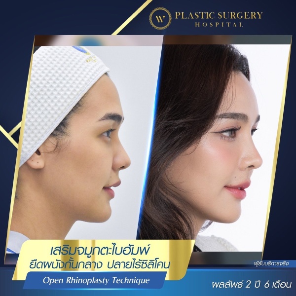 Nose Surgery