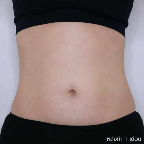 Liposuction