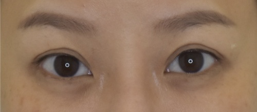 ศัลยกรรมแก้ไขปัญหาหนังตา