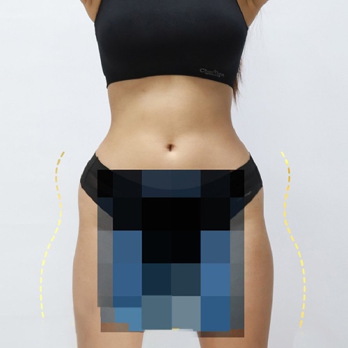 Liposuction