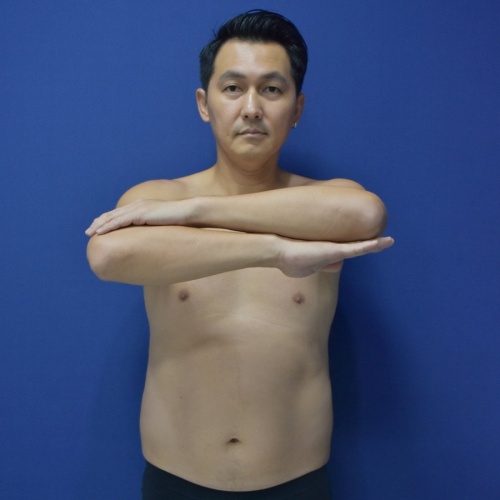Liposuction