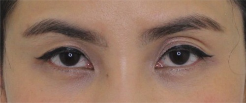 ศัลยกรรมแก้ไขปัญหาหนังตา